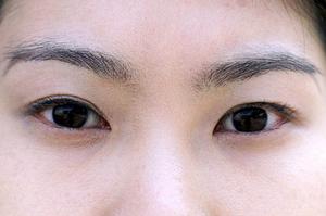 練馬区で粉瘤を徹底予防・治療するための最新対策ガイド【2025年版】